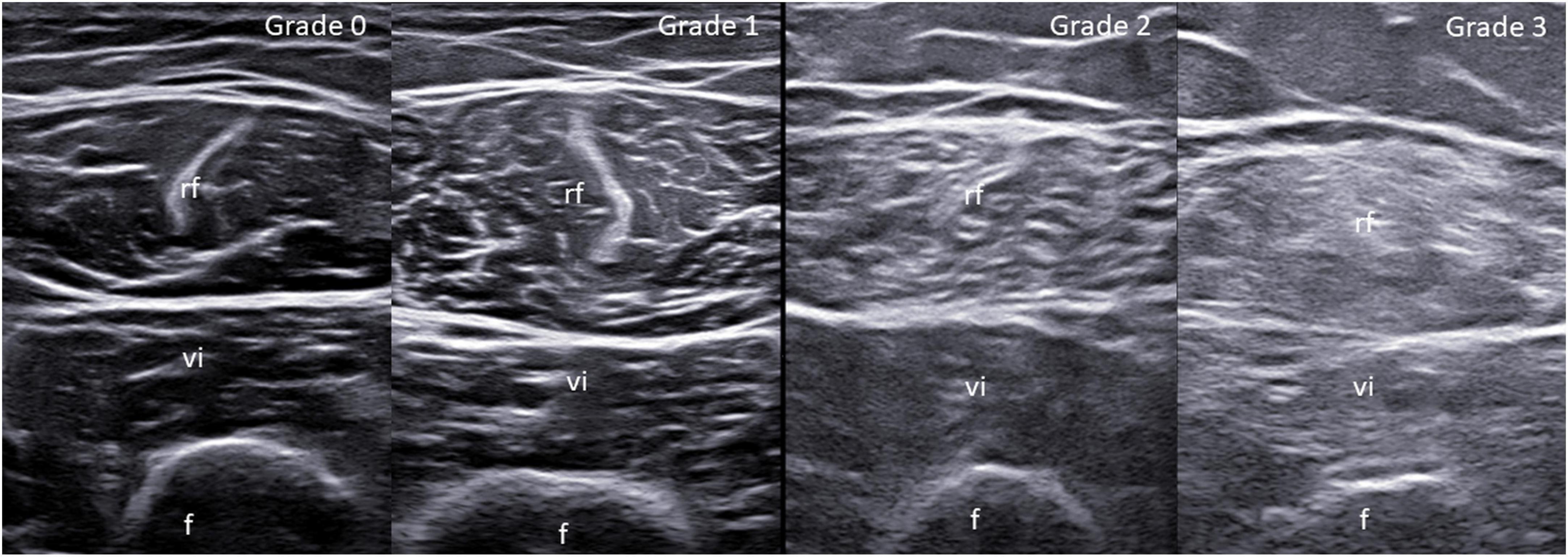 Reliability assessment of ultrasound muscle echogenicity in patients with rheumatic diseases: Results of a multicenter international web-based study